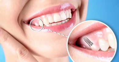 dental implants